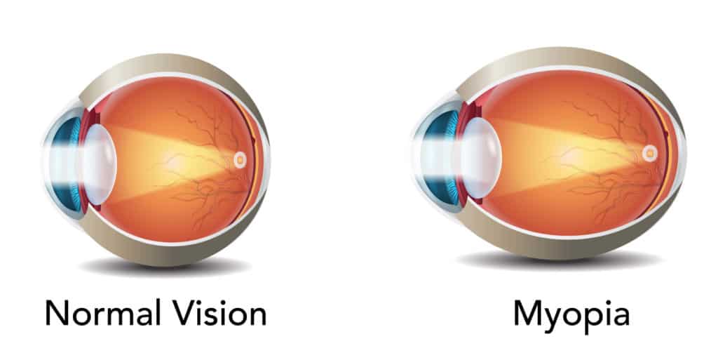 Myopia Signs and Symptoms