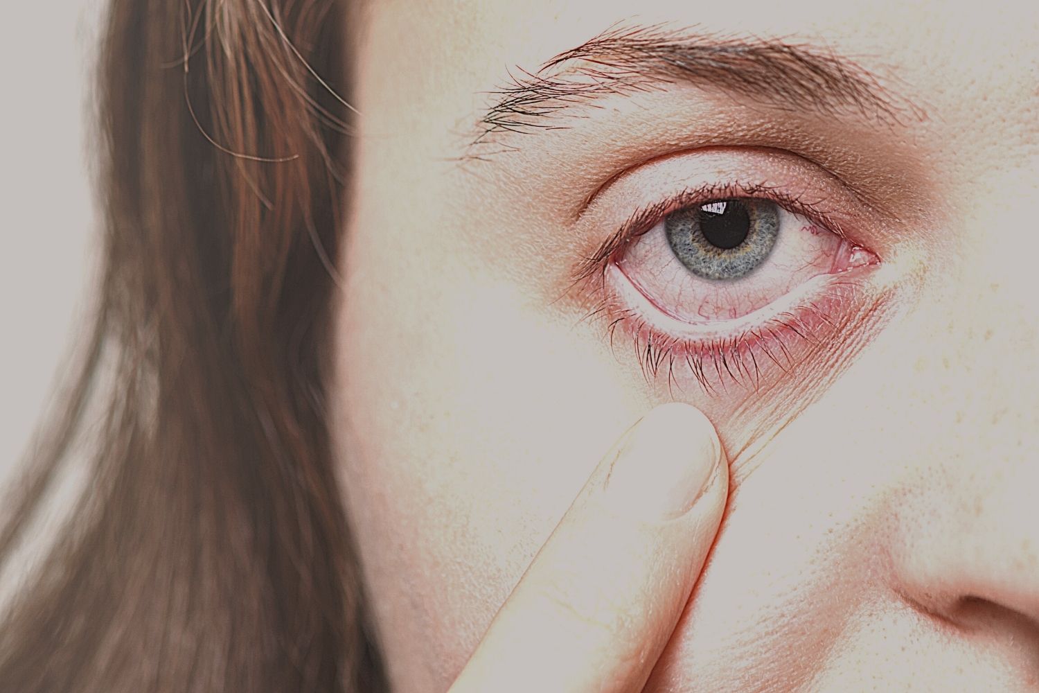 sleeping with contact lenses may causes keratitis