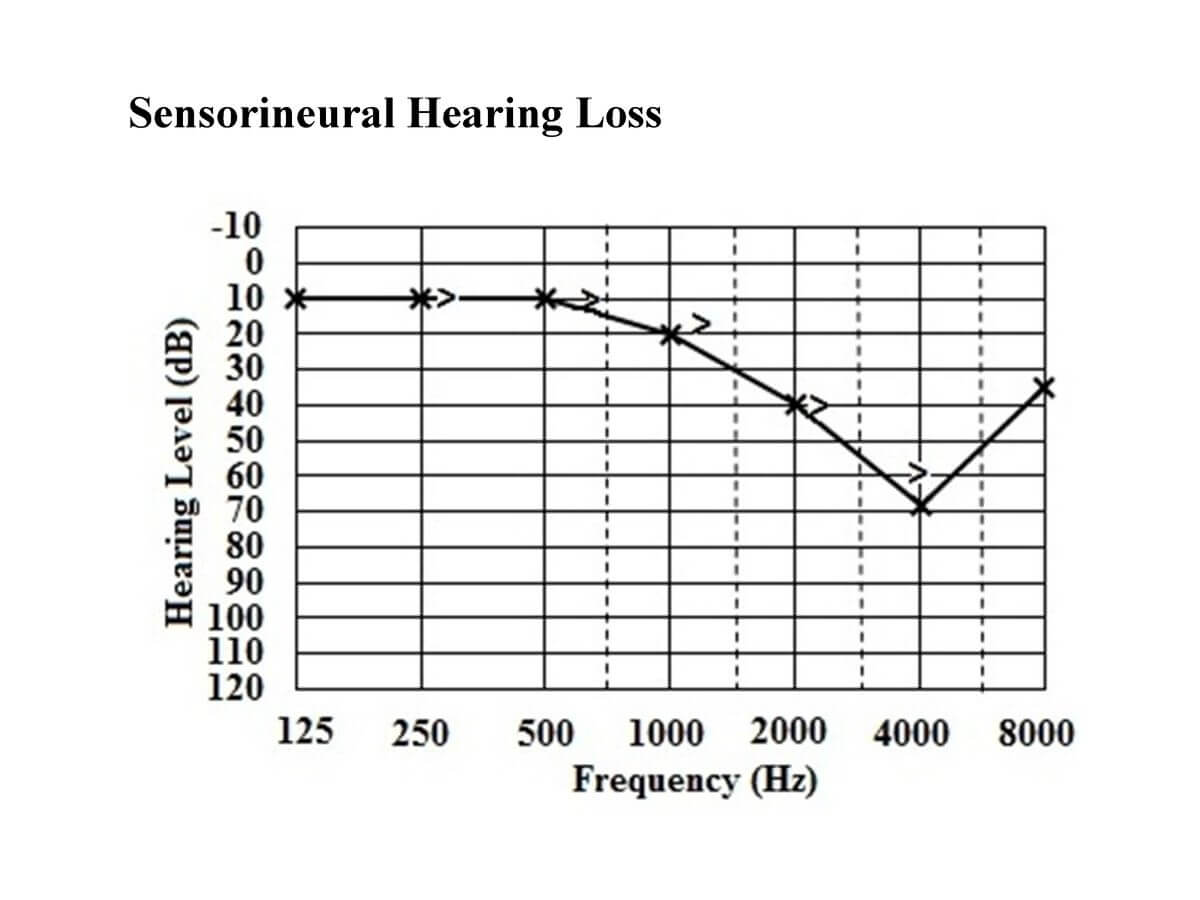 hearing threshold of a sensorineural hearing loss audiogram
