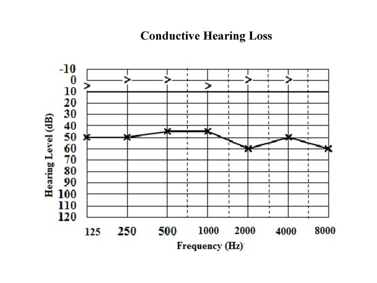 hearing thresholds of a conductive hearing loss audiogram