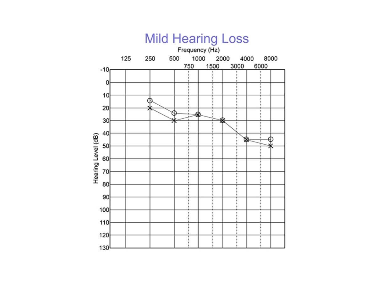mild hearing loss audiogram is between 25 to 40 db HL