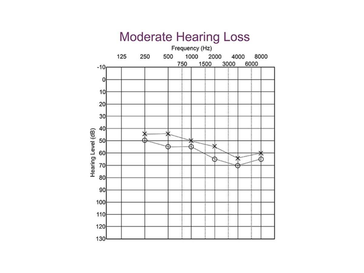 moderate hearing loss audiogram is between 41 to 65 db HL