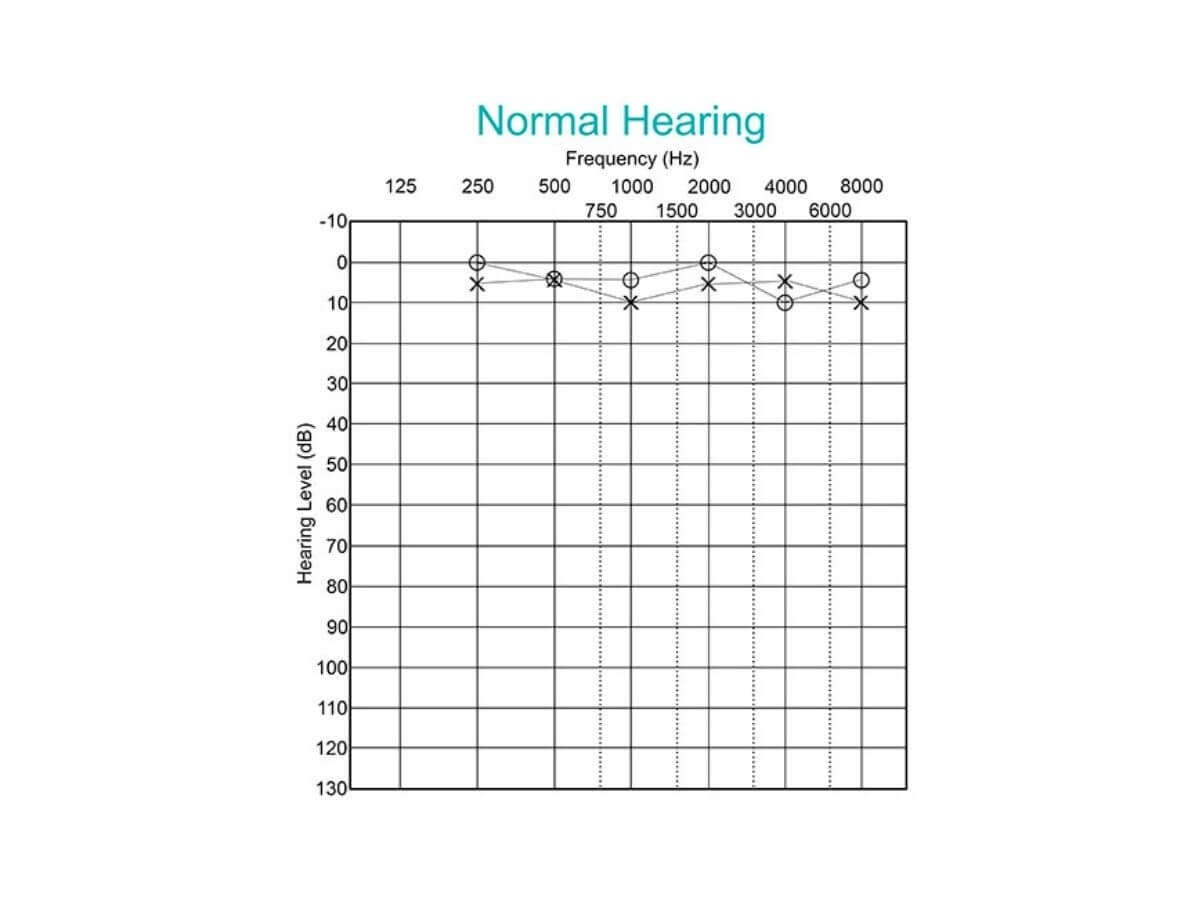 normal hearing audiogram is less than 25 db HL