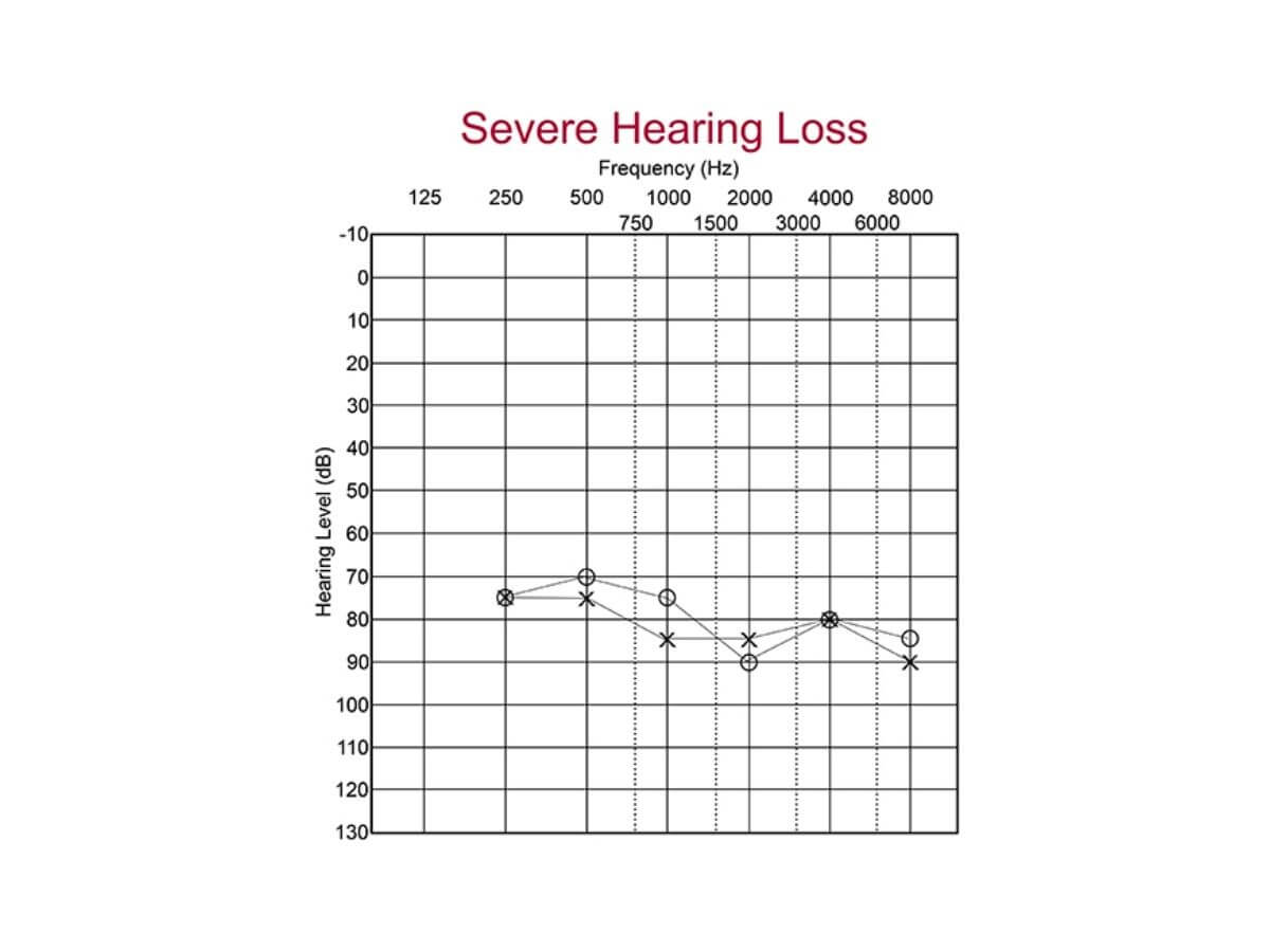 severe hearing loss audiogram is between 66 to 90 db HL