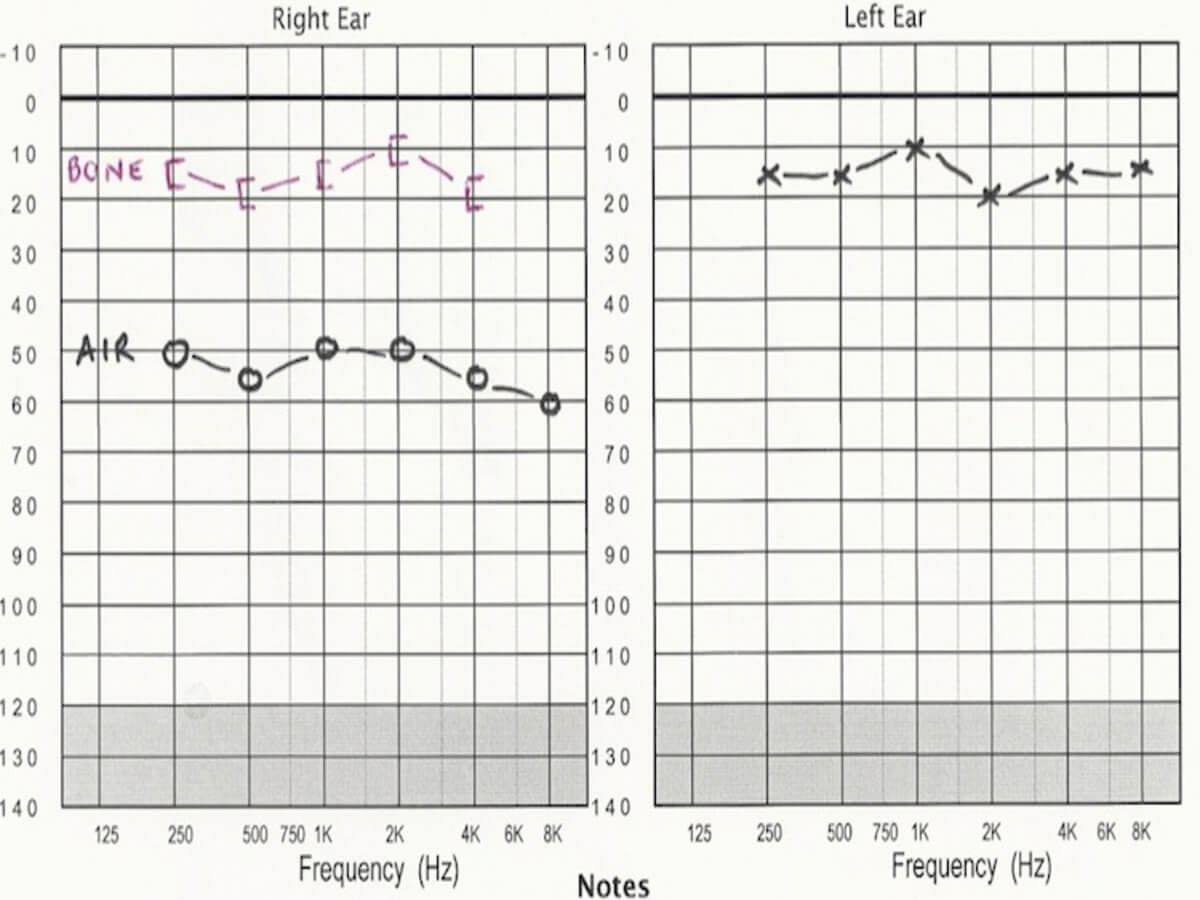 audiograms when conductive hearing loss occurs